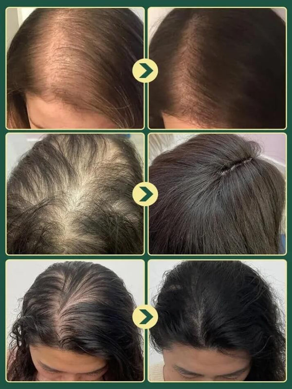 Rosemary Hair Growth Shampoo - Doctor-Recommended Scalp & Hair Care Formula