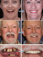 Medical-Grade Silicone Braces - Japanese-Style Orthodontic Comfort Aligners