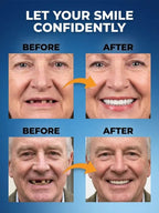 Medical-Grade Silicone Dental Veneers - Invisible Comfort-Fit Cosmetic Teeth Covers Crafted by Zurich Dental Experts