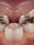 Teeth & Gum Repair Oral Patches - Fast Relief for Sensitivity & Gum Care